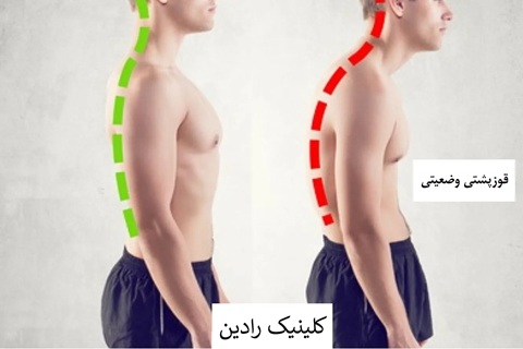 انواع قوز کمر