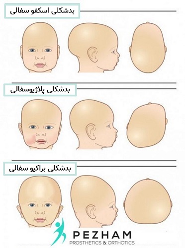 بد شکلی های سر نوزاد