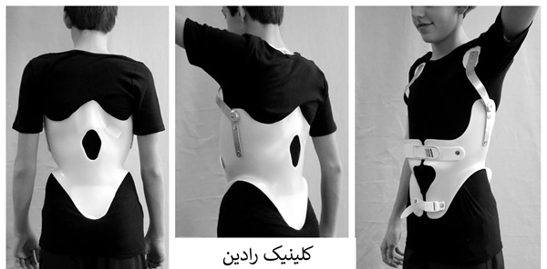 درمان قوزپشتی