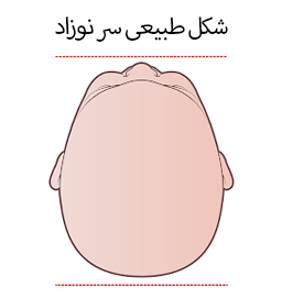 شکل طبیعی سر نوزاد