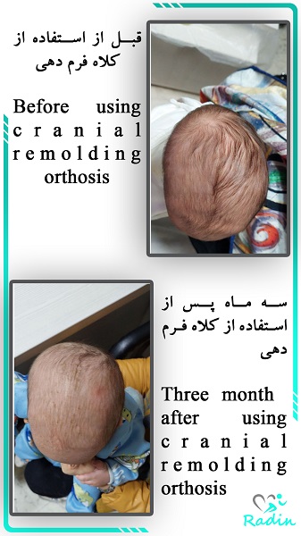 قبل و بعد از استفاده از کلاه فرم دهی دو