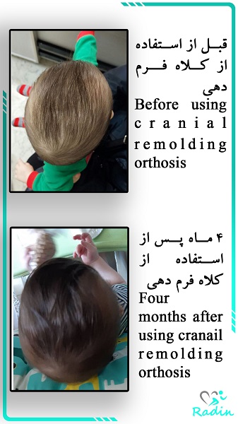 قبل و بعد از استفاده از کلاه فرم دهی یک