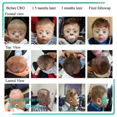 اطلاع بد فرمی سر نوزاد با کلاه فرم دهی سر نوزاد