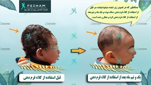 درمان بدفرمی نوزاد با کلاه فرم دهی سر نوزاد