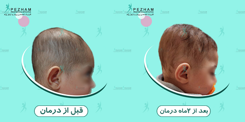 اصلاح بد فرمی سر نوزاد با کلاه فرم دهی سر نوزاد