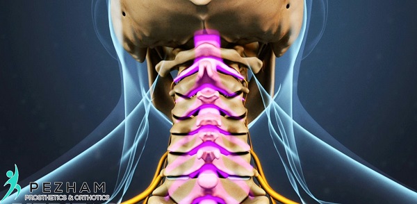 تنگی کانال نخاعی گردن