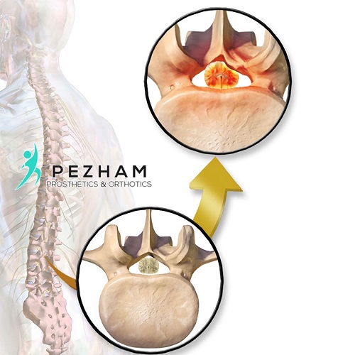 تنگی کانال نخاعی کمر