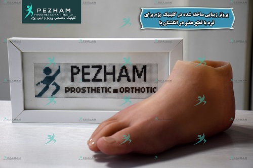پروتز پنجه سلیکونی ساخته شده در کلینیک پژم