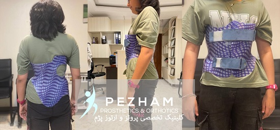 درمان اسکولیوز با بریس شنو