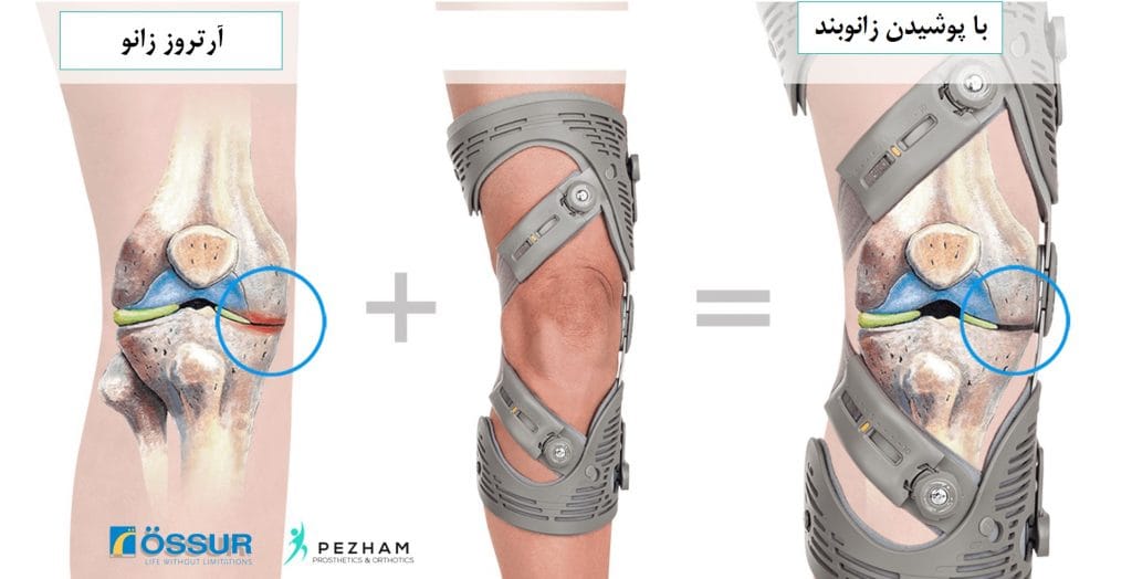 تاثیر زانوبند طبی بر روی آرتورز زانو