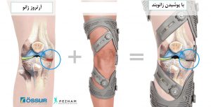 تاثیر زانوبند طبی بر روی آرتورز زانو
