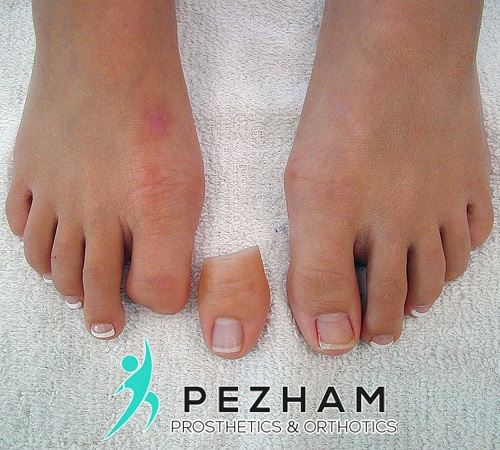 پروتز قطع انگشت شست پا