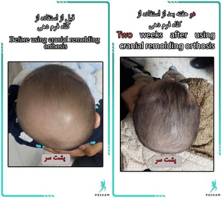بدشکلی جمجمه و اصلاح با کلاه فرم دهی سر نوزاد