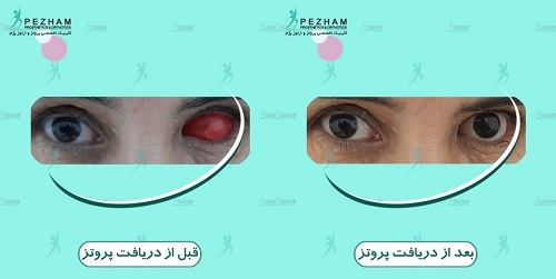 مرکز ساخت چشم مصنوعی کلینیک پژم