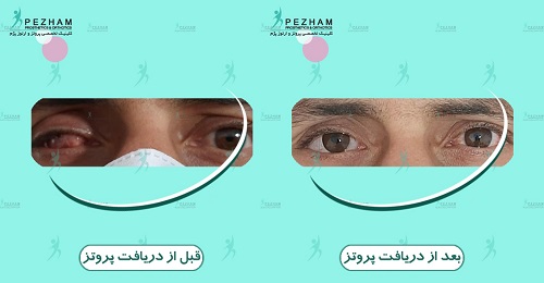 ساحت چشم مصنوعی در کلینیک پژم