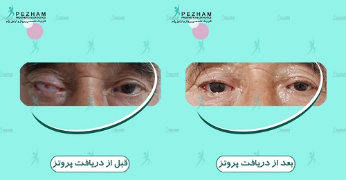 پروتز چشم یا چشم مصنوعی در کلینیک پژم