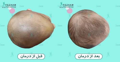 اصلاح فرم سر نوزادان با کلاه فرم دهی سر نوزاد