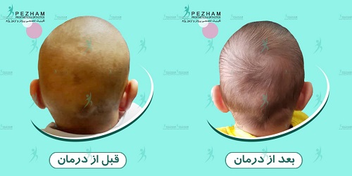 کلاه فرم دهی سر نوزادان