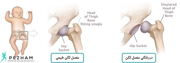 دررفتگی مادرزادی لگن در نوزادان