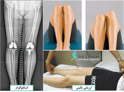 روش های تشخیص کوتاهی پا