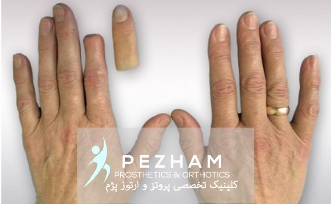 پروتز قطع انگشتان دست
