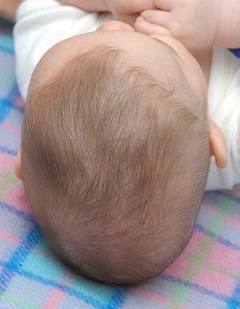 اسکافوسفالی از نمای بالای سر