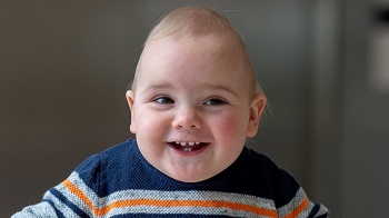 بدشکلی اسکفوسفالی یا اسکافوسفالی (سر خربزه ای)