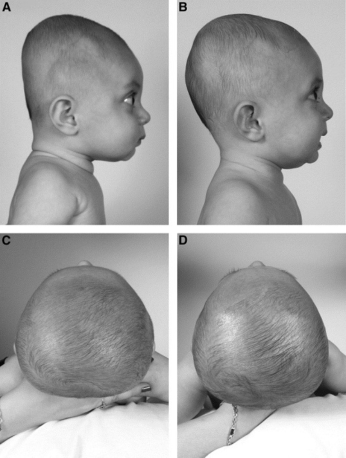 براکی سفالی یا پشت سر صاف
