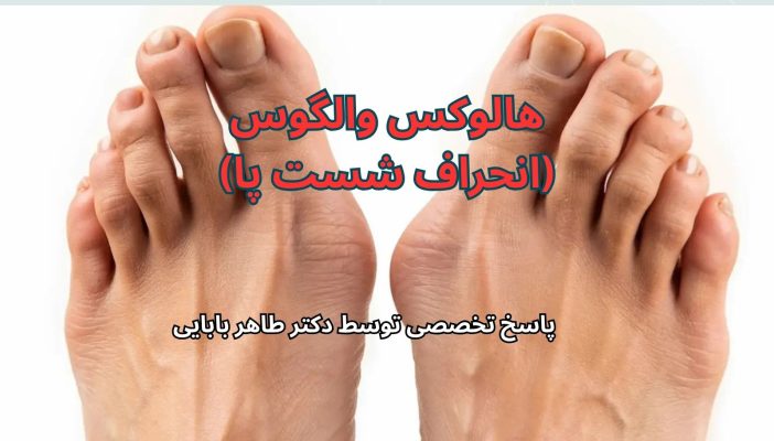 هالوکس والگوس را بشناسید